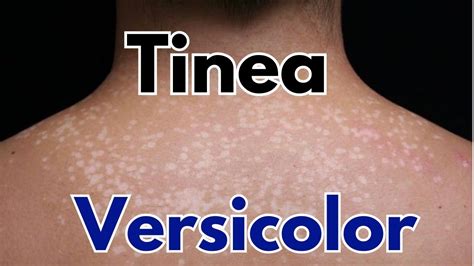 Tinea Versicolor Symptoms Treatment How To Get Rid Of Tinea