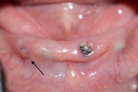 Abscess Like Formation In Implant Zone How Would You Proceed