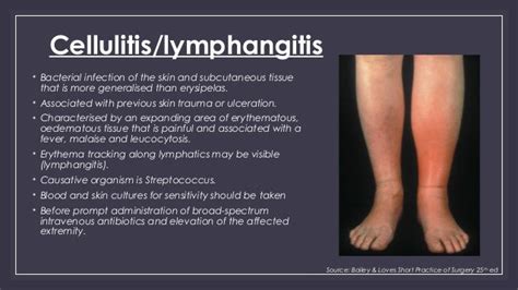 Cellulitis On Foot Pictures Photos
