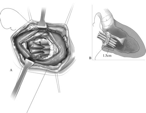 Melody Valve For Mitral Valve Replacement Operative Techniques In