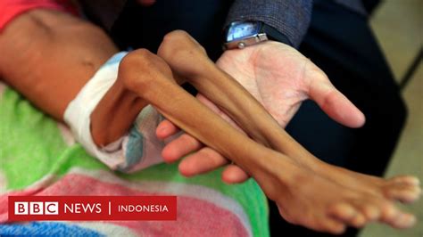 Covid 19 Ratusan Juta Orang Terancam Kelaparan PBB Minta Sumbangan