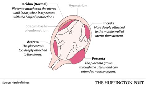 Pregnancy Related Complications Explained Hubpages