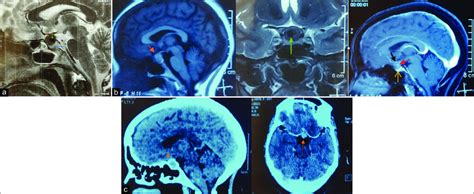 A Magnetic Resonance Imaging Brain Sagittal T2 Sequence Showing