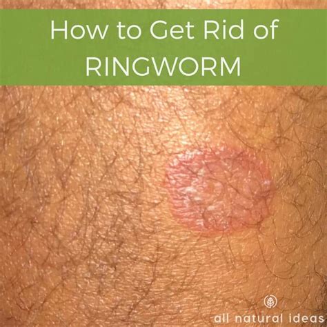 How To Get Rid Of Ringworm Fast With Natural Methods All Natural Ideas