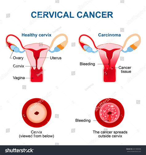 Cervical Cancer Malignant Neoplasm Arising From Cells In The Cervix