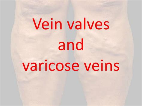 Ppt Vein Valves And Varicose Veins Powerpoint Presentation Free