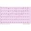 Inferior Wall MI ECG Example 3  Learn The Heart