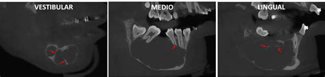 Mixoma Odontogénico Dento Metric Radiología Dental Oral Y Maxilofacial