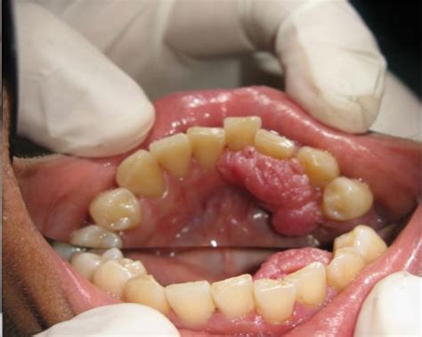 Figure From Recurring Peripheral Ameloblastoma At Mandibular Premolar