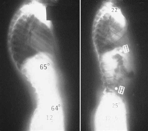 Kyphosis Roundback Of The Spine Orthoinfo Aaos