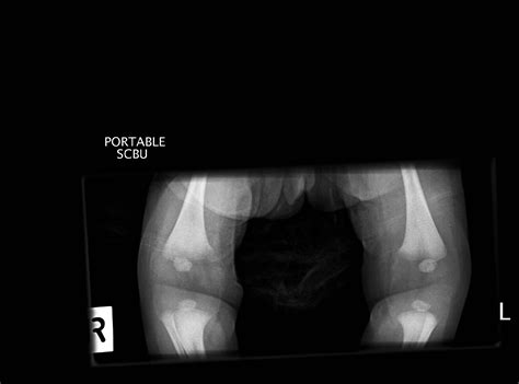 Normal Pediatric Bone Xrays