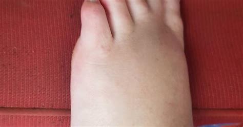 Swollen Foot Album On Imgur