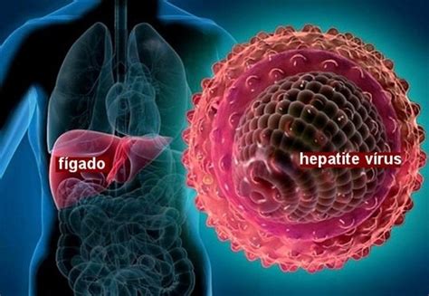 Hepatite C Causas Sintomas E Tratamentos Dicas De Saúde