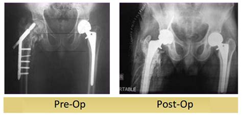 Conversion Of Failed Dhs To Total Hip Replacement