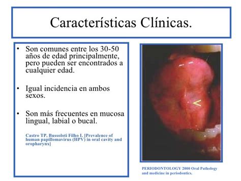 Patologia Oral Infección Papiloma Humano