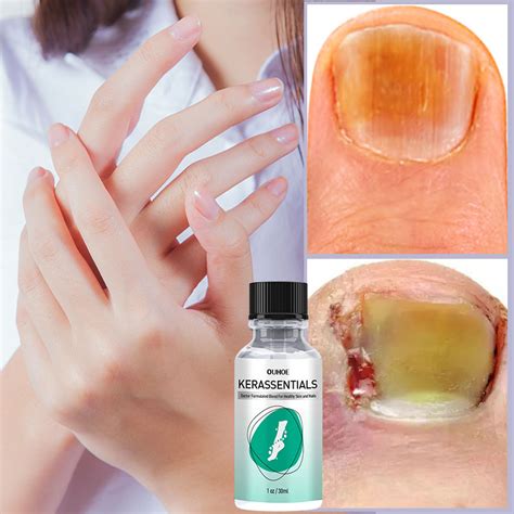 Repair Nail Fungus Treatments Essence Eliminate Toes Stop Itching Foot