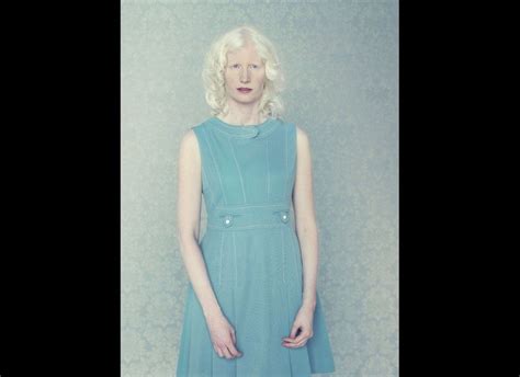 Stunning Photos Of Models With Albinism Capture The Beauty In Breaking