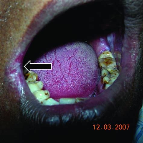 Atrophic Glossitis Of Tongue Photo Shows Atrophic Glossitis Or Bald