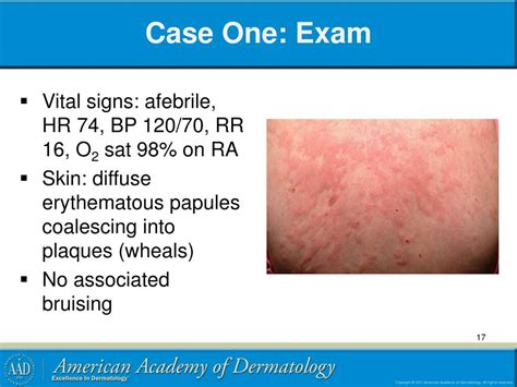 Ppt Urticaria Powerpoint Presentation Free Download Id4827313