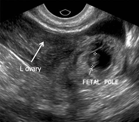 Ectopic Pregnancy A Trainees Guide To Making The Right Call Womens Imaging Radiographics