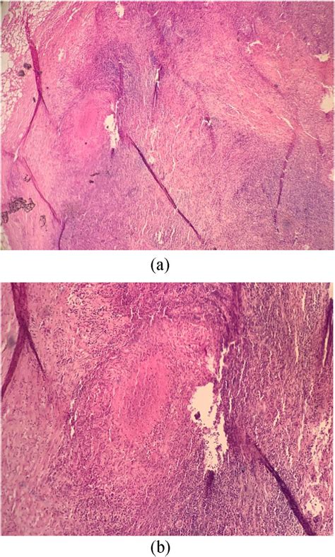 Microphotograph Of Lymph Node Showing Granuloma With Caseating Necrosis Download Scientific