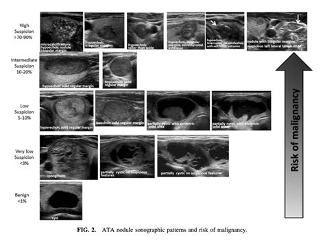 甲状腺良性結節のエコー診断とataeu Tirads分類 ページ 2