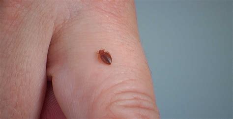 Home Remedies For Chiggers Tips And Information
