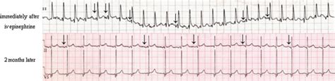 Wandering Atrial Pacemaker Rhythm Strip