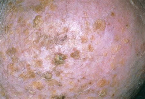 Seborrhoeic Dermatitis On Elderly Person S Scalp Stock Image M My Xxx