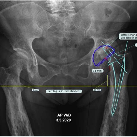 Preoperative Anteroposterior Pelvis Radiograph With Templating Using