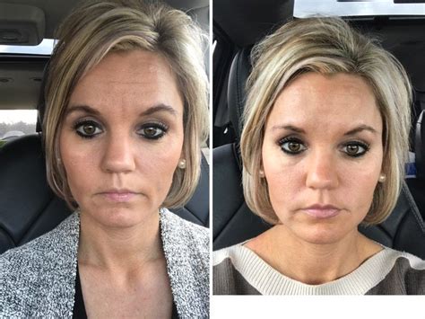 Botox And Fillers Before And After Botox Fillers Botox Forehead Botox