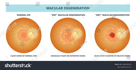 Macular Dystrophy Retina