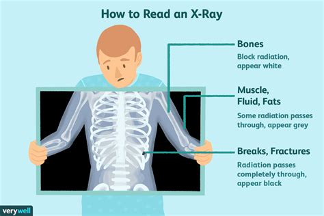 X-Rays: Uses, Procedure, Results