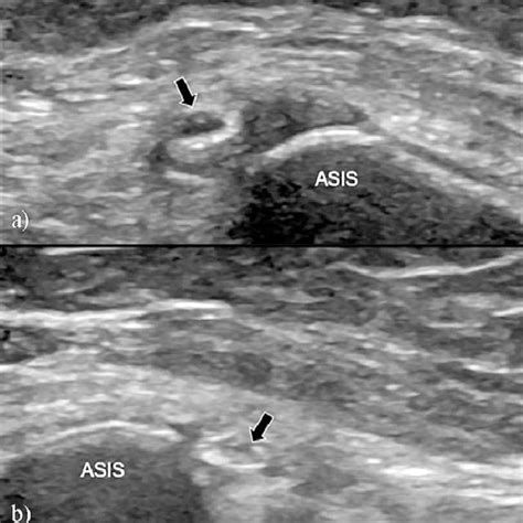 Transverse Ultrasonographic Image Of The Lateral Femoral Cutaneous