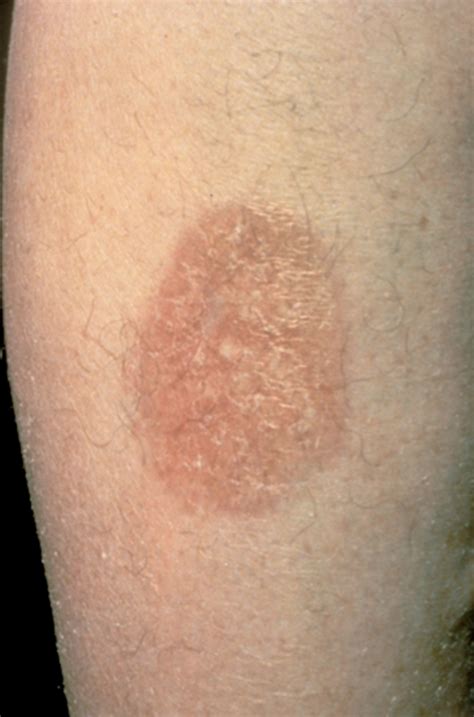 Diabetic Skin Conditions Pictures Pictures Photos
