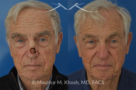 Mohs Repair Of Nose Skin Cancer With Forehead Flap Maurice M Khosh