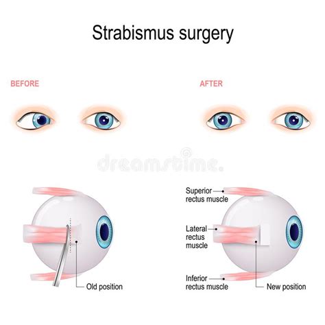 Strabismus Stock Vector Illustration Of Esotropia Convergent 28300621