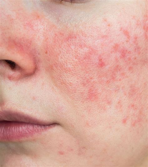 Rosacea Conditions Premier Dermatology