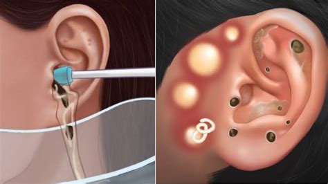 Asmr Ear Pimple Blackhead Sebaceous Cyst Removal Water Device Youtube