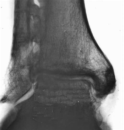 Treatment Of Malunited Fractures Of The Ankle Bone And Joint