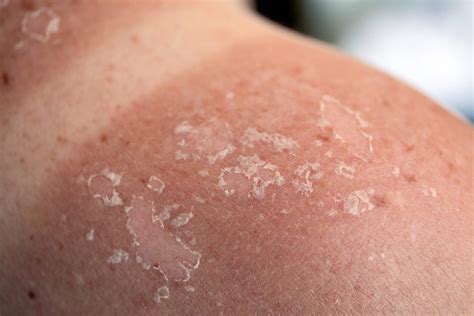 Things Dermatologists Need You To Know About Skin Cancer The Healthy