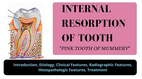 Internal Resorption Of Tooth I Pink Tooth Of Mummery I Odontoclastoma I