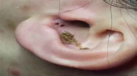 Satisfying Giant Ear Blackhead Removal Best Of 2019 Youtube