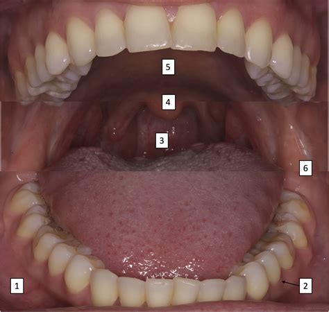 Benign Oral Mucosal Lesions Clinical And Pathological Findings
