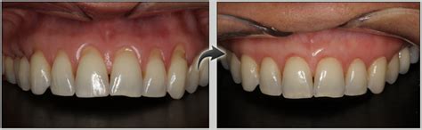 Gum Rejuvenation Pinhole Surgical Technique Southview Dentistry