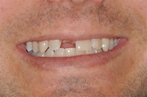 Replace Missing Teeth With Dental Implants In Newburgh In