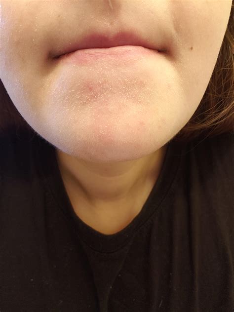 Misc For About The A Year And A Half I Have Had Problems With My Chin