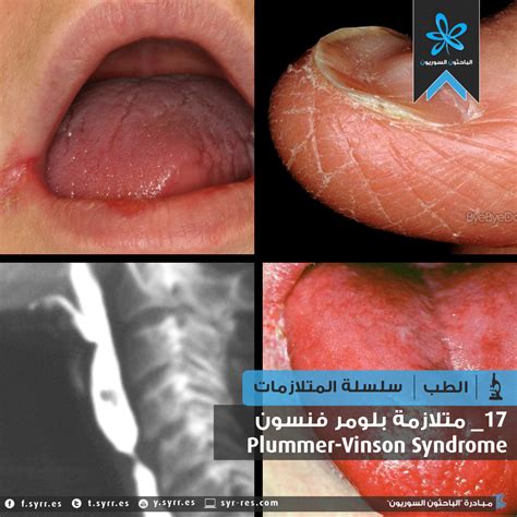 Medical Pictures Info Plummervinson Syndrome