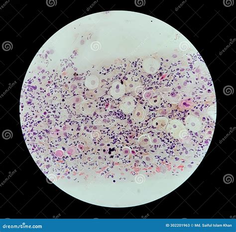 Photomicrograph Of Paps Smear Inflammatory Smear With Vaginal