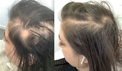 Hashias Alopecia Before And After Prp And Exciplex Treatment Este